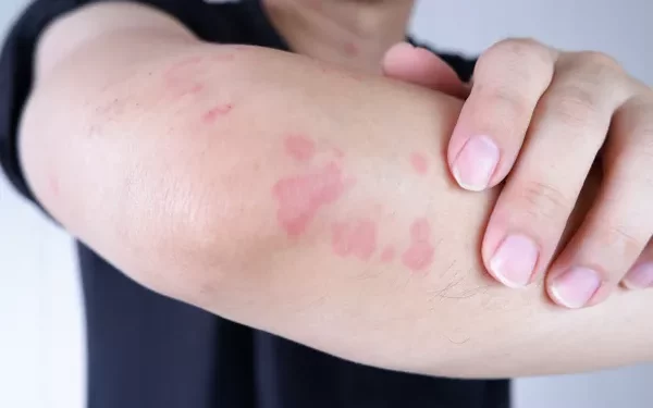 Can Urticarial Vasculitis Kill You? Understanding the Risks and Management