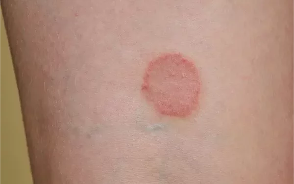 Does Ringworm Cause Blisters?