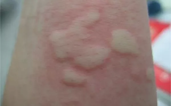 What Are Internal Hives