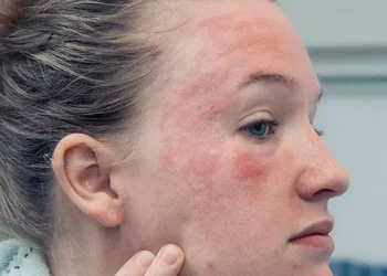 How to Treat Eczema Patches on Face