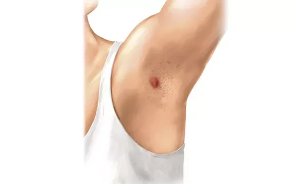 How to Treat Hidradenitis Suppurativa Armpit
