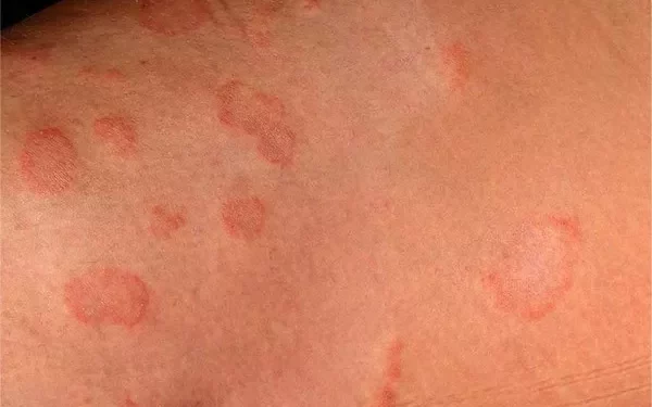 Why Do I Keep Getting Tinea Corporis