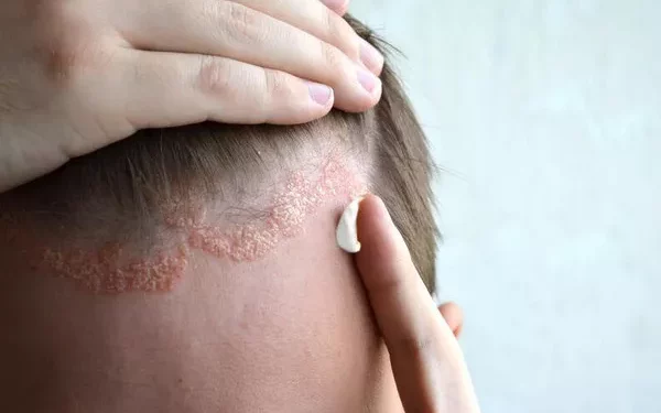 How to Treat Sebaceous Dermatitis