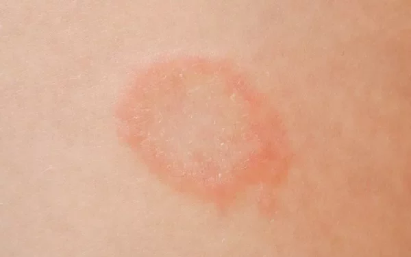Why Does Ringworm Keep Spreading on My Body