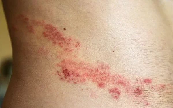 Can Adults Get Shingles When Exposed to Chickenpox?
