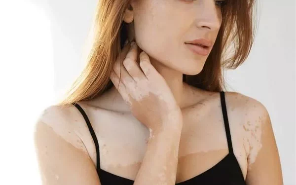 Can Vitiligo Go Away Naturally?