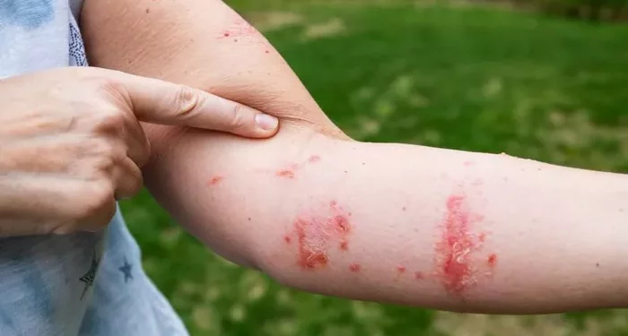 Is Shingles Infection Contagious