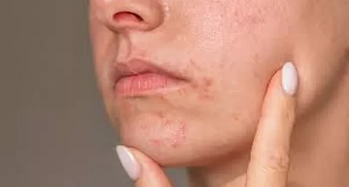 How to Treat Perianal Dermatitis