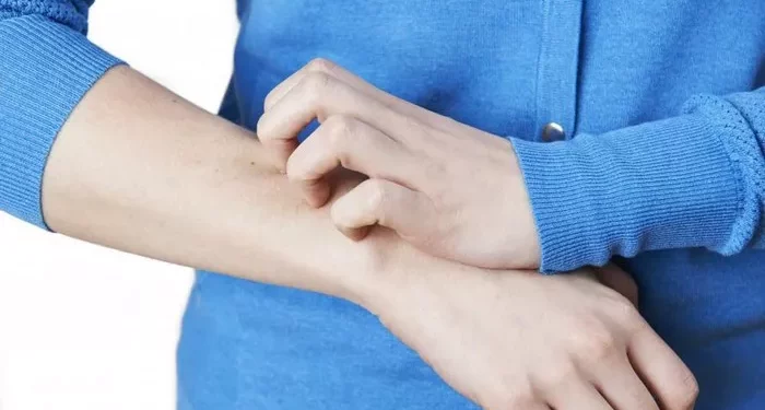 What Can Cause Hives on Hands