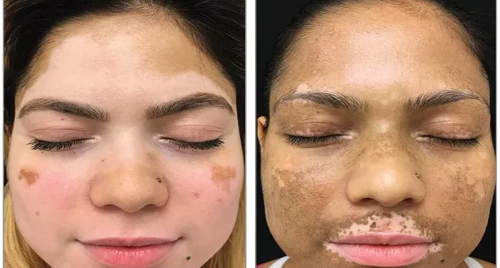 Best Treatment for Lip Vitiligo