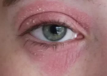 Eczema Around Eyes How to Treat？