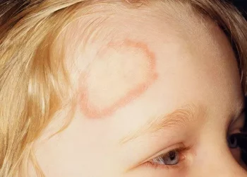 How Bad is Ringworm in Humans?