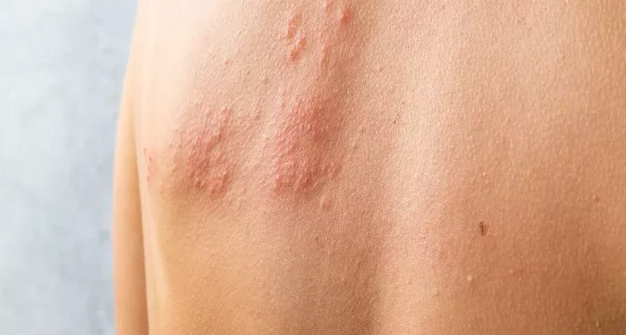 How Long After Taking Antivirals Is Shingles Contagious