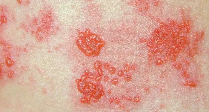 How Long Do You Stay Contagious with Shingles