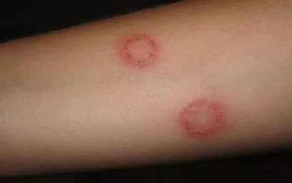What Cream Can Be Used for Ringworm?