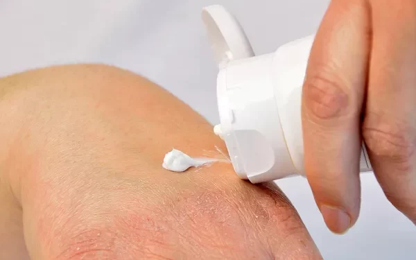 Best Steroid Cream for Eczema: A Comprehensive Guide