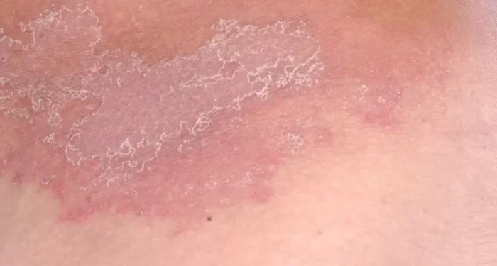 Best Treatment for Tinea Corporis