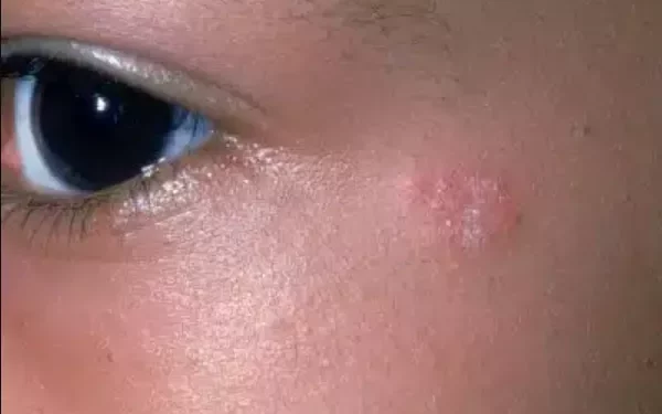 Can I Get Ringworm on My Face?