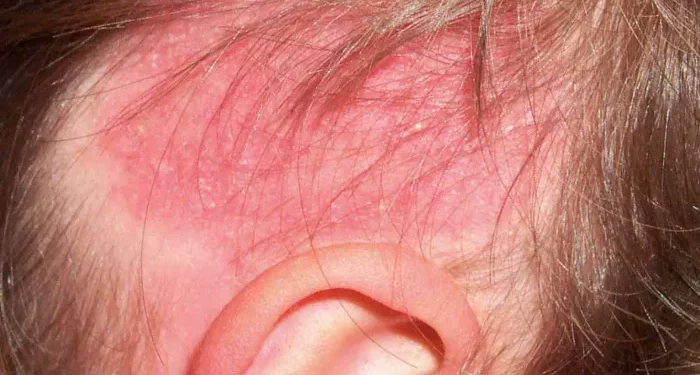 Does Scalp Ringworm Cause Permanent Hair Loss