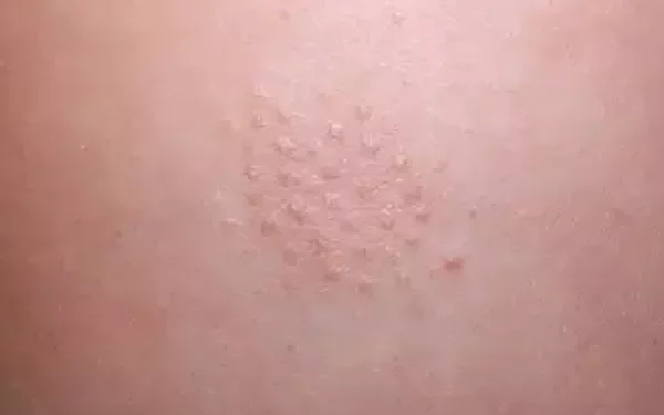 Follicular Eczema Treatment: A Comprehensive Guide
