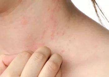 How to Get Rid of Eczema on Arms Fast?