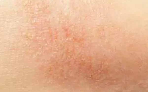 What Does Fungal Dermatitis Look Like?