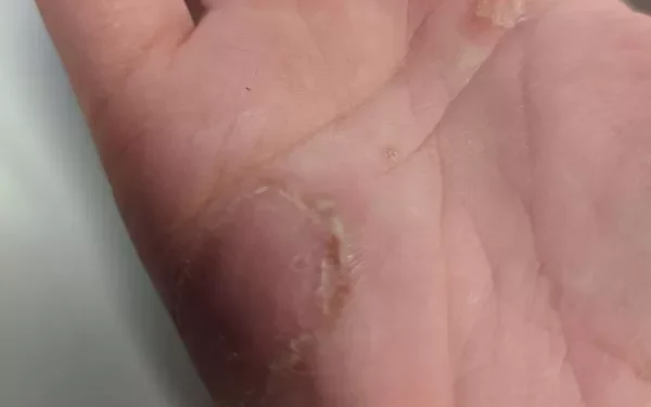 What Does Ringworm Look Like on a Finger