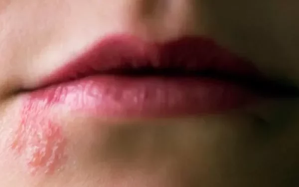 What is the Incubation Period for Shingles Exposure?