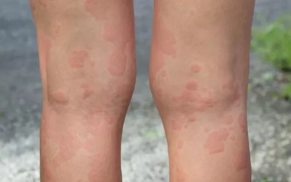 Where on the Body Does Shingles Occur?