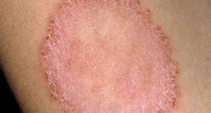Why Is Ringworm Coming Back?