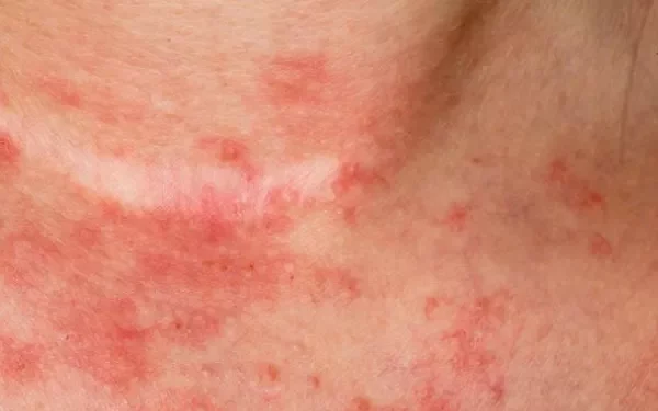 How Does Eczema Spread on Your Body?