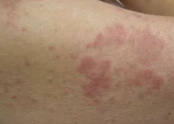 What Is Dermatomycosis?