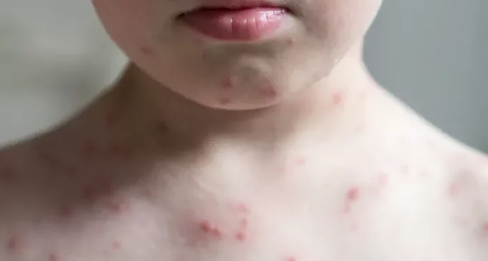 What is Herpes Varicella?