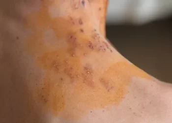 5 Common Side Effects of the Shingles Vaccine